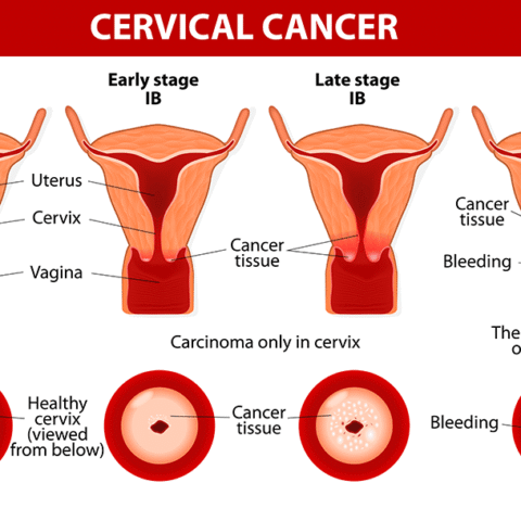 Cervical Cancer screening- VIA